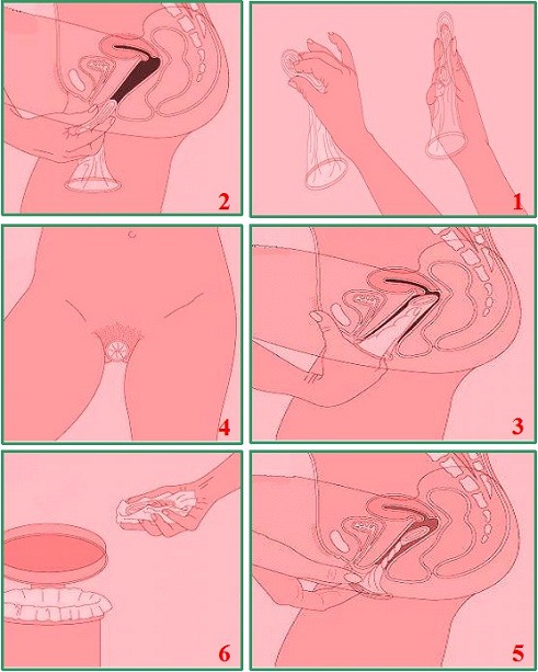 ژنان هیچ شاره‌زاییه‌كیان ده‌رباره‌ی (كۆندۆمی مێینه‌) نییه‌